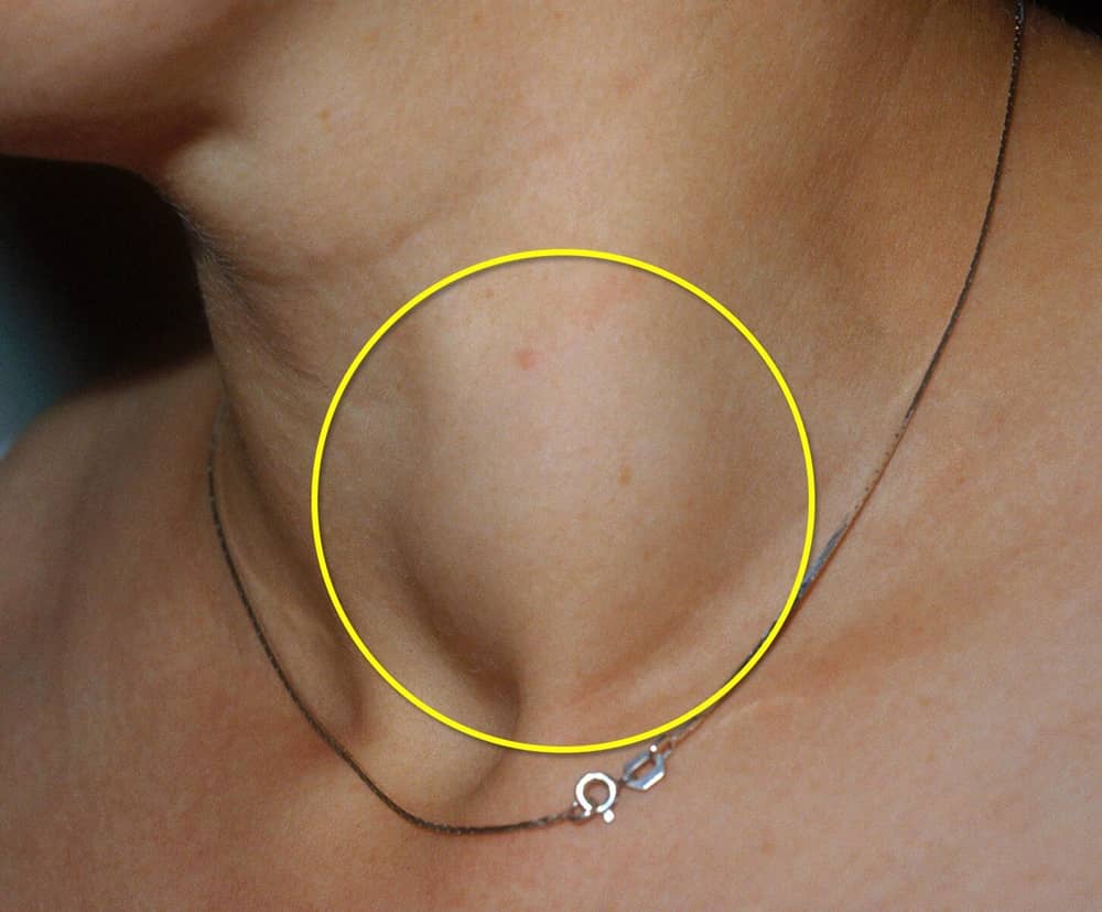 علایم سرطان تیرویید