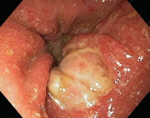 عکس سرطان معده