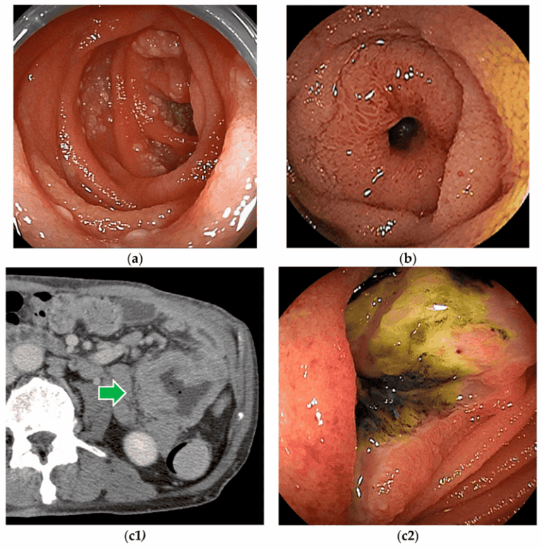 سرطان روده کوچک