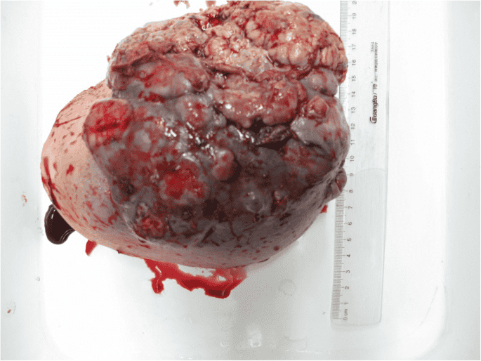 عکس توده سینه