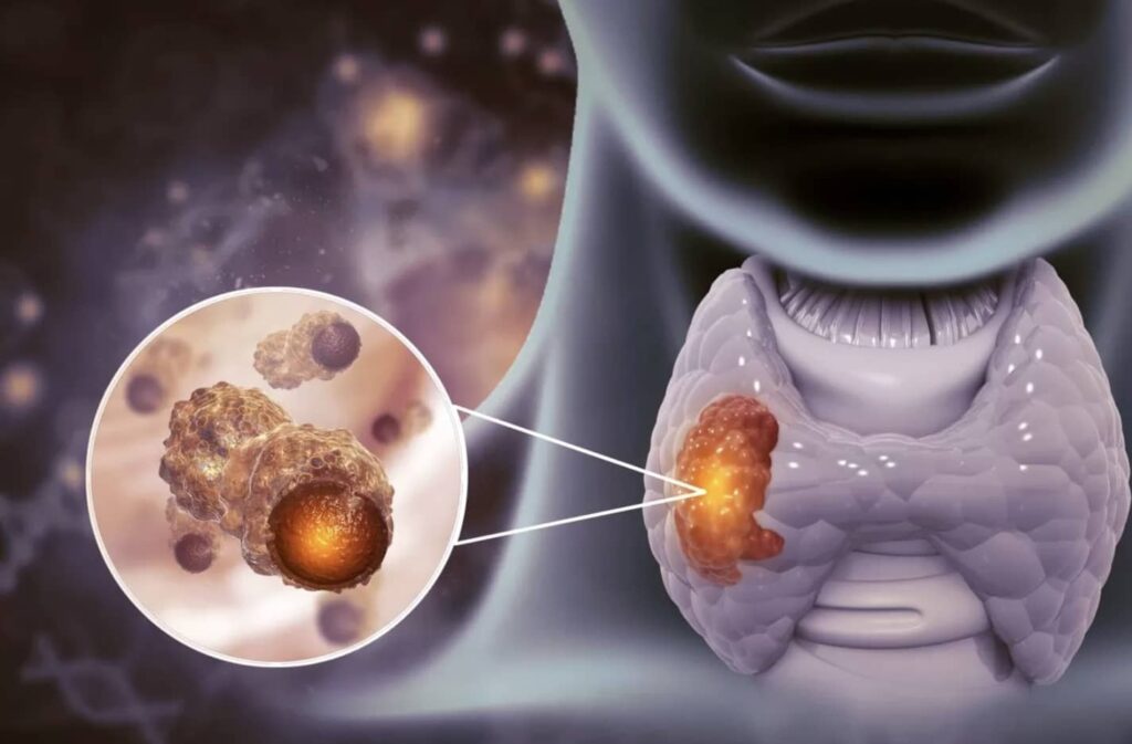 عکس سرطان تیرویید