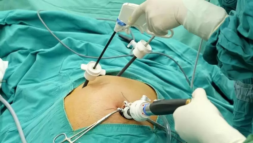 جراجی سنک صفرا با لاپاراسکوپی