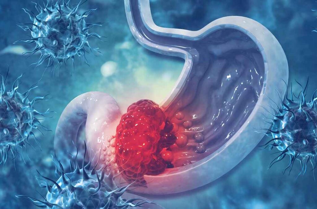 علائم اولیه سرطان معده