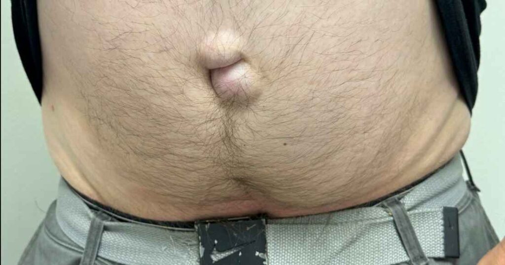 عکس فتق پاره شده