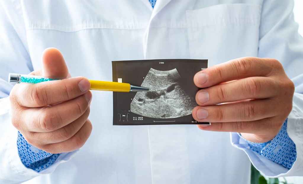 عکس پولیپ صفرا