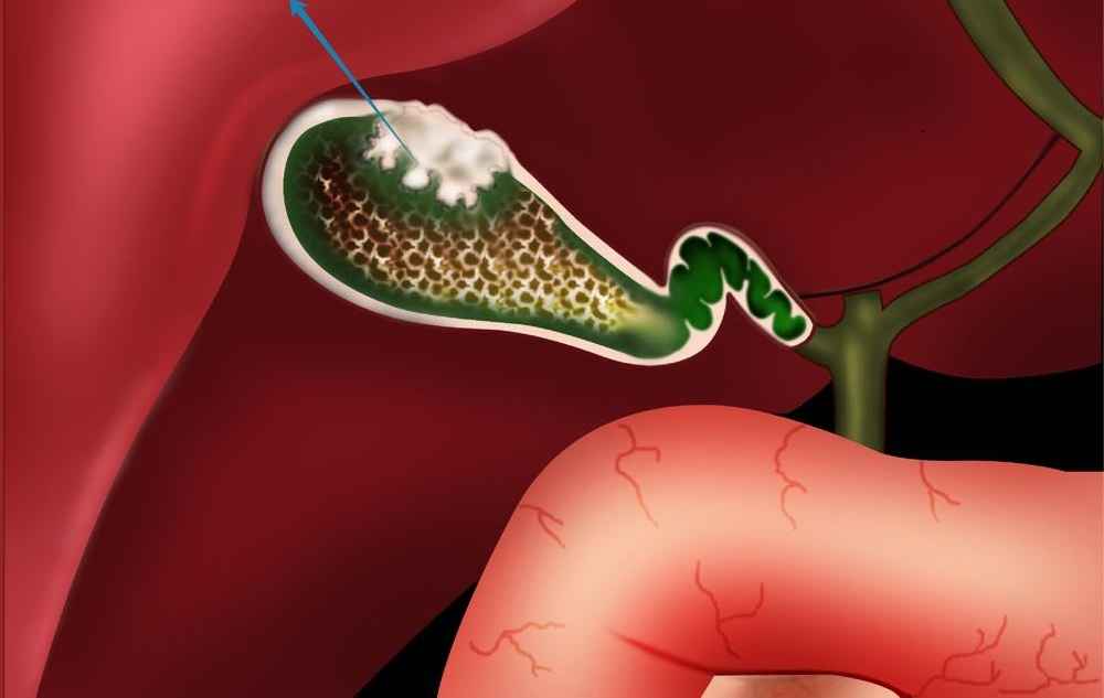 عکس اندازه نرمال پولیپ کیسه صفرا