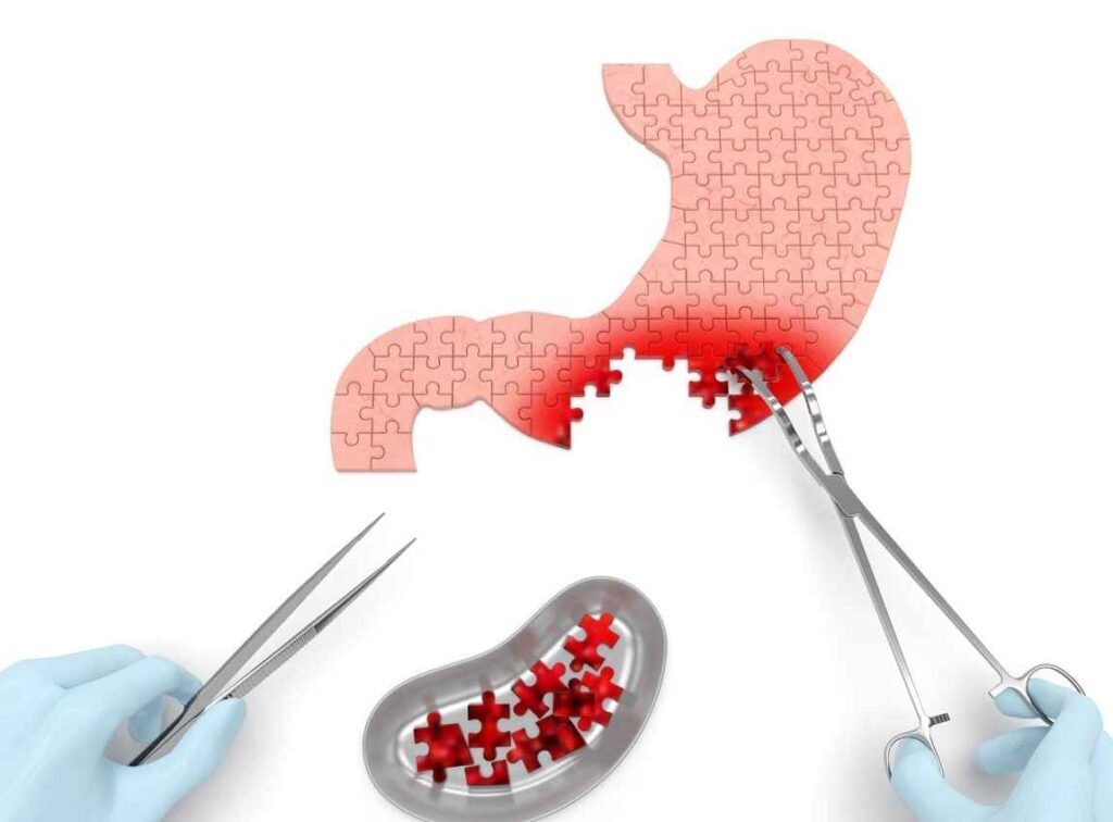 معجزه درمان سرطان معده با جراحی