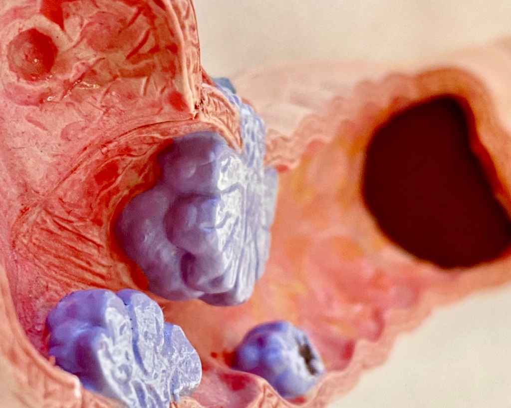 عکس سرطان روده