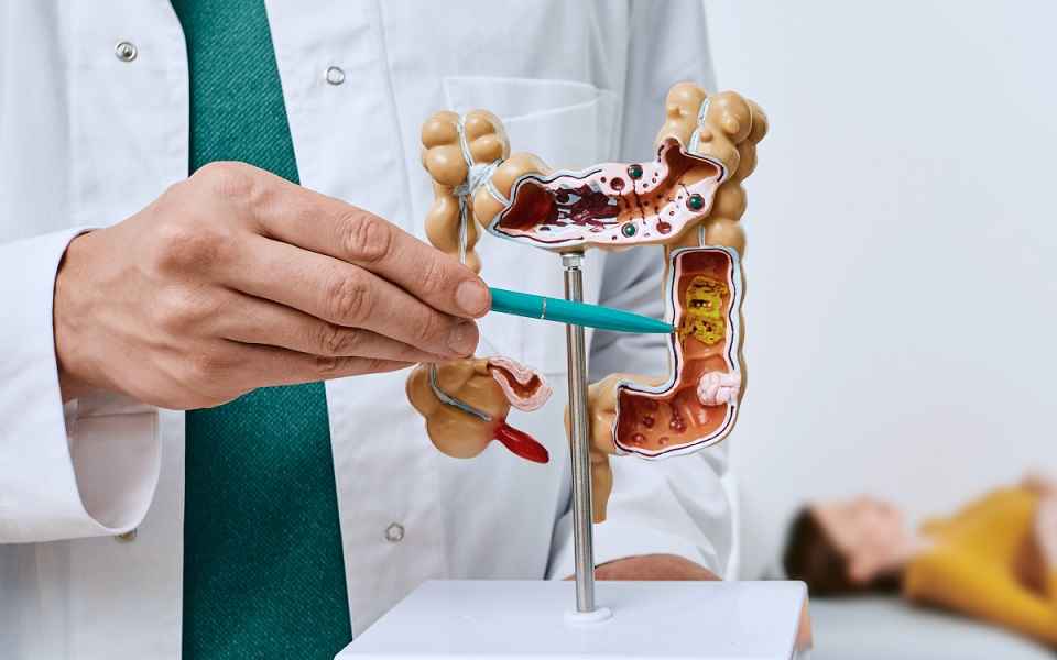 عوامل خطر سرطان روده بزرگ