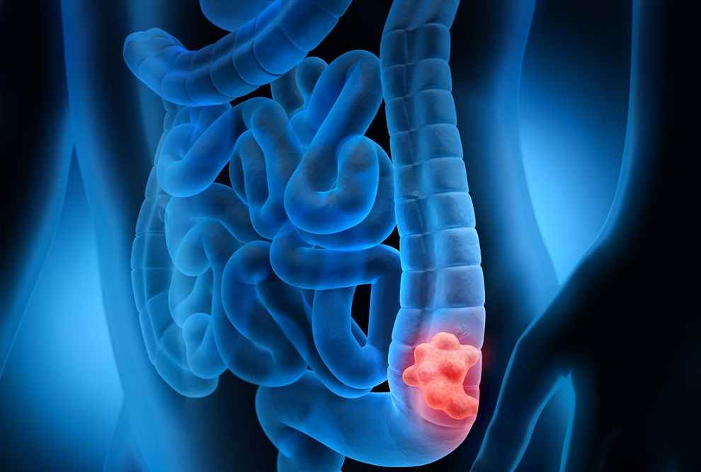 سرطان رکتوم یا روده بزرگ چقدر کشنده است