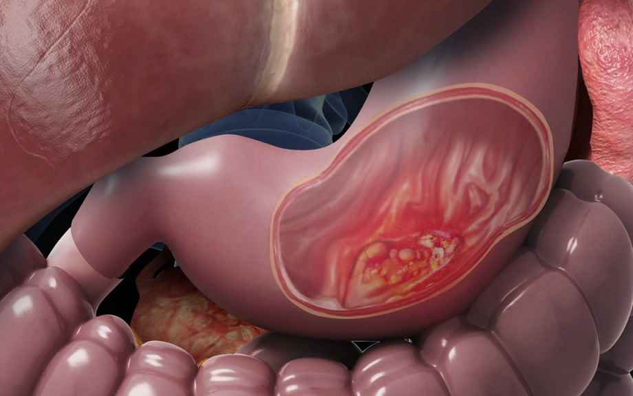 سرطان معده خطرناک