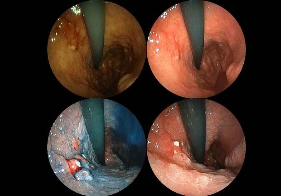 عکس معده با دوربین