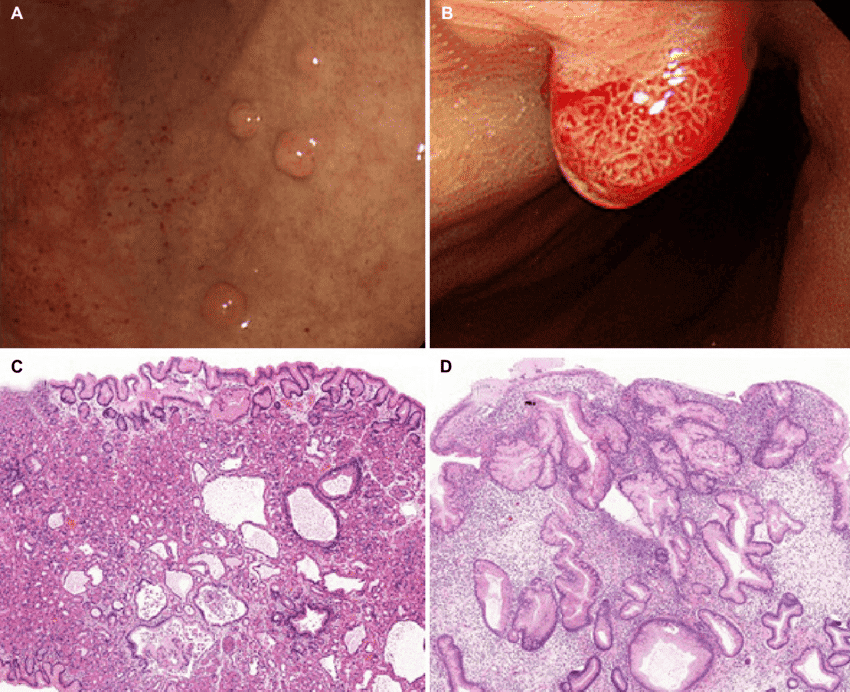 پولیپ‌های غدد فوندیک
