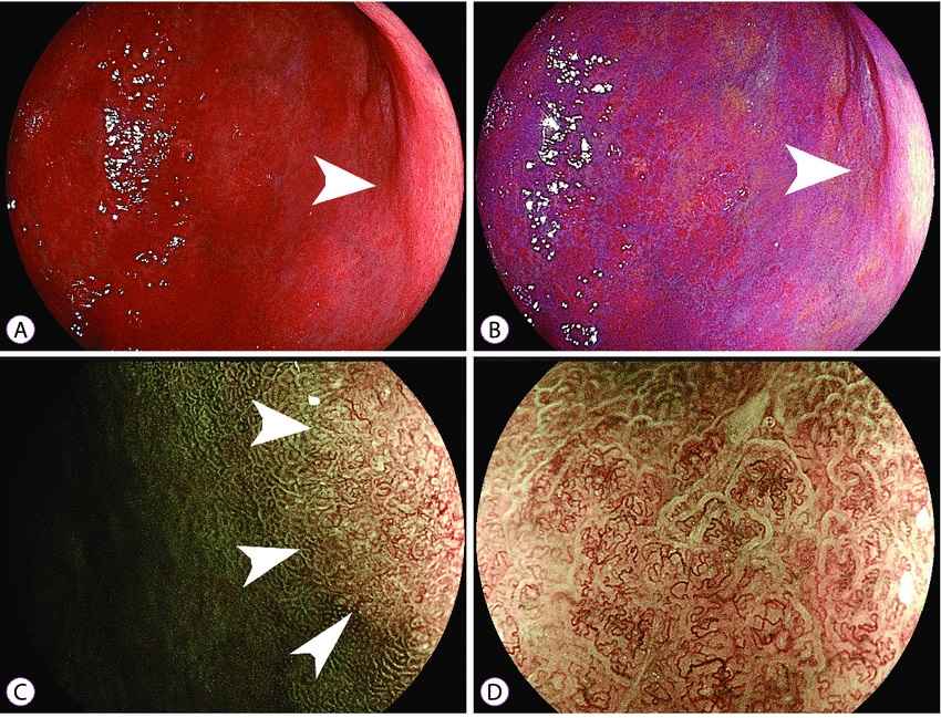 آندوسکوپی سرطان معده