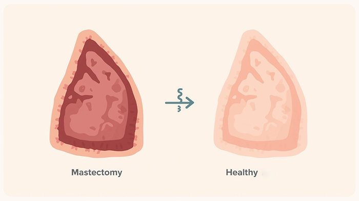 چه کسانی کاندید جراحی پستان هستند؟